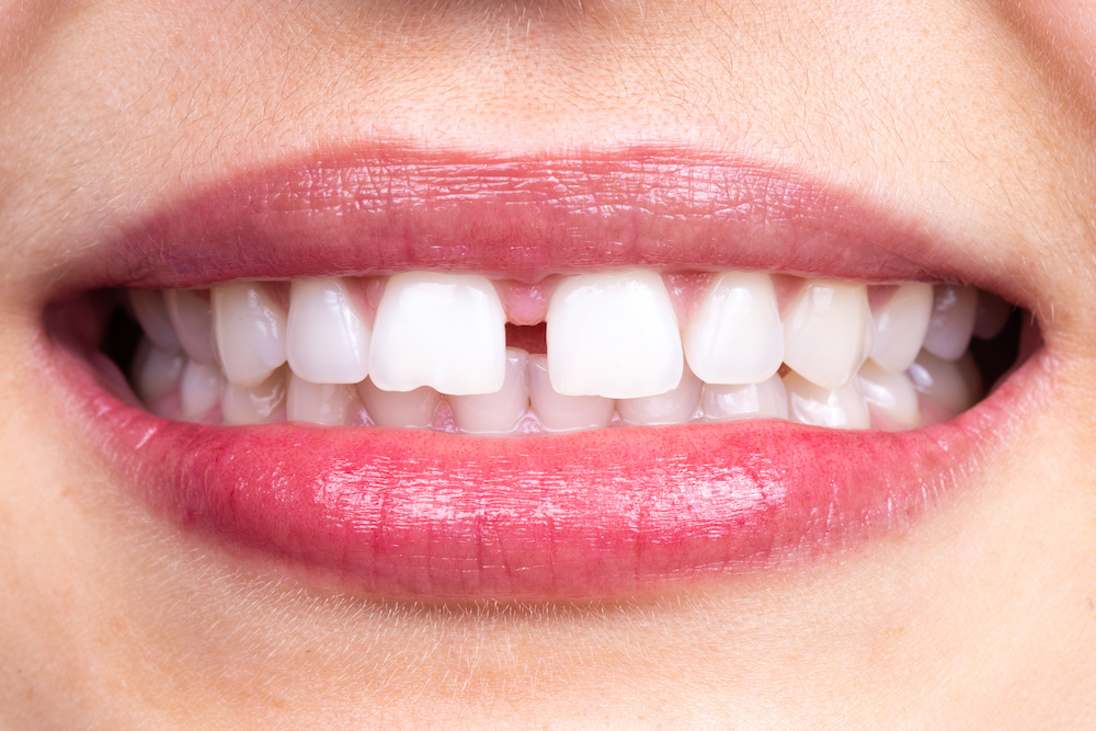 インビザラインですきっ歯は治せる？インビザラインのすきっ歯治療について