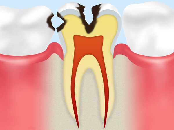 C2 象牙質の虫歯