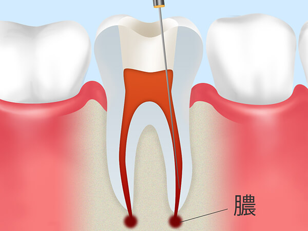 重度の虫歯を抜かずに治療「根管治療」とは