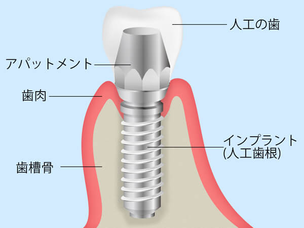 インプラント治療とは