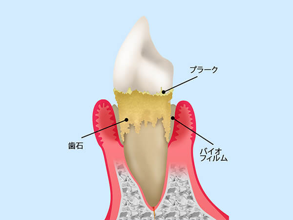 歯周病の原因について