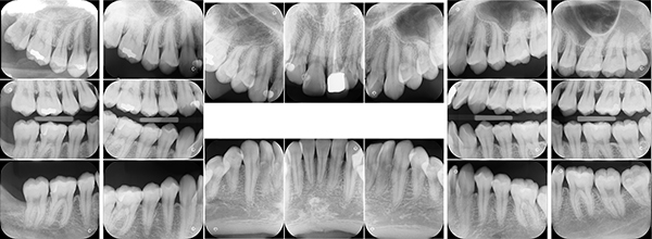 デンタルレントゲン写真18枚法