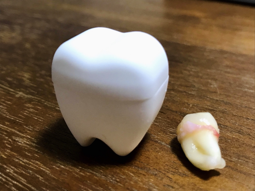 出っ歯をインビザラインで治療するのに抜歯は必要？