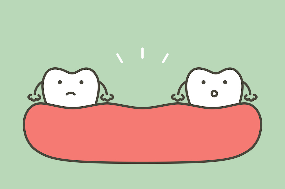 インビザラインですきっ歯を治療する2つの方法