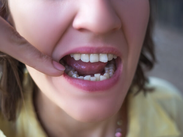 インビザラインでガチャ歯は治せる？ガタガタ歯並びの治療について
