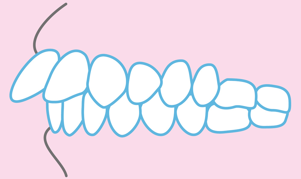 出っ歯の原因によってインビザラインでの治しやすさが変わります