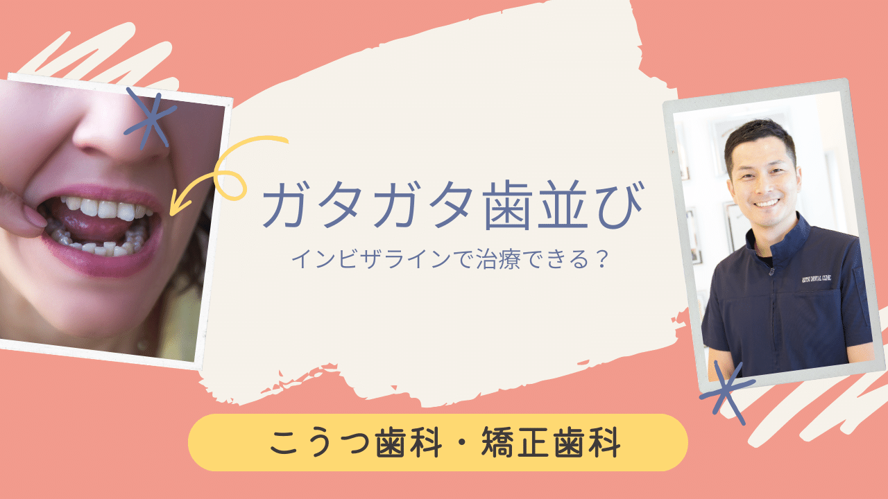 インビザラインでガチャ歯は治せる？ガタガタ歯並びの治療について